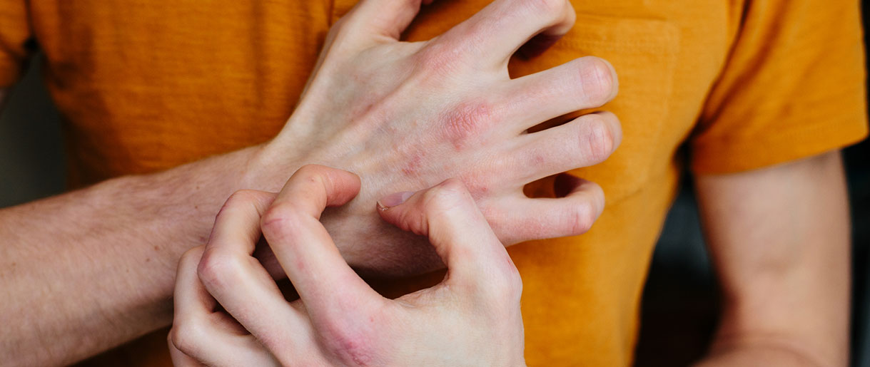 Chaga For Psoriasis: Can Chaga Treat Psoriasis?